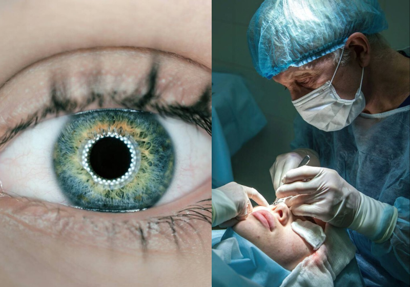 A nova técnica para aposentar os óculos, apresentada por cientistas dos Estados Unidos, remodela a córnea usando uma pequena corrente elétrica e uma espécie de lente de platina. - Foto: reprodução/redes