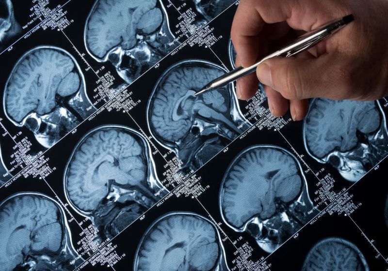 Cientistas de três paísesconseguiram reverter o Alzheimer pela primeira vez, em camundongos, com uma terapia inovadora. - Foto: Getty/iStock