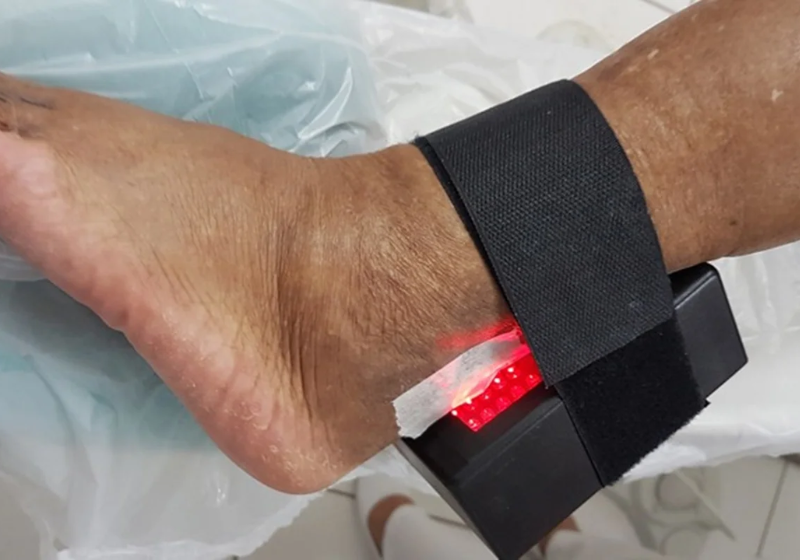 A pesquisadora brasileira Suélia Rodrigues, da UnB (Universidade de Brasília) criou um aparelho que acelera a cicatrização de feridas em diabéticos e evita amputações. - Foto: UnB