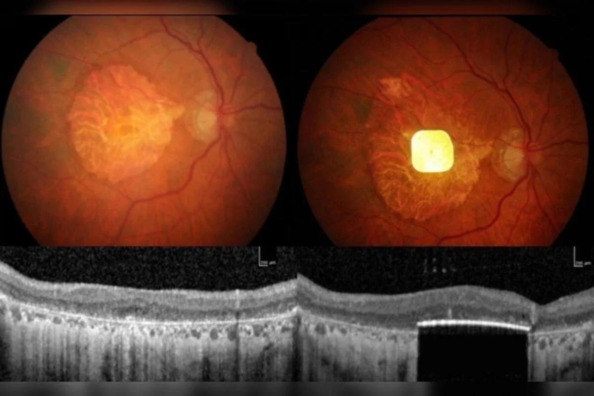Antes e depois da retina de um paciente após o implante. - Foto: Science Corporation