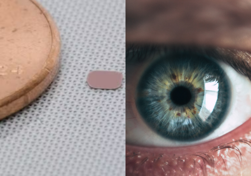 O novo implante de retina, desenvolvido nos Estados Unidos, consegue devolver parte da visão de pacientes com cegueira total. - Foto: Science Corporation/Canva