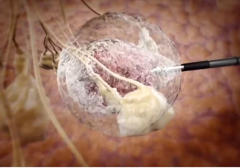 A nova técnica utiliza crioablação para destruir tumores de câncer de mama de até 2 cm - Foto: Reprodução/EPTV