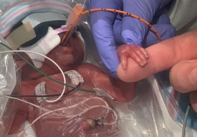 O bebê prematuro Gabriel Golden ficou 350 dias na UTI Neonatal do Hospital Vanderbilt, no Tennessee (EUA). - Foto SWNS