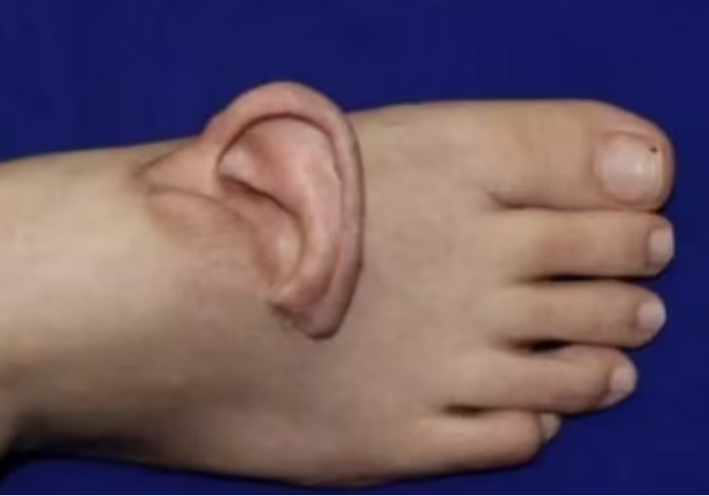 Os médicos conseguiram reimplantar a orelha, através de um enxerto no pé - Foto: Dumireo