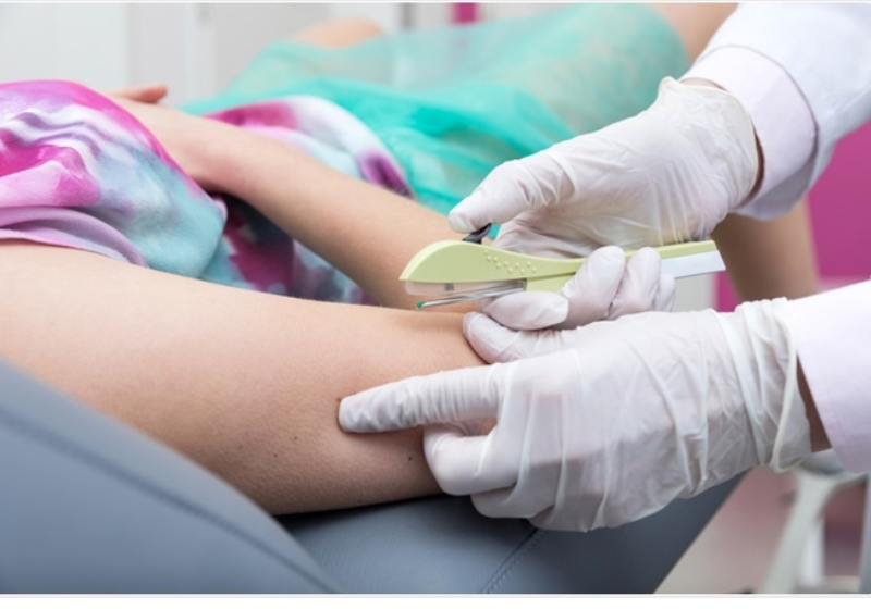 O SUS fará um mutirão para realizar o implante do Implanon em mulheres de várias partes do Brasil - Foto: Gov.br