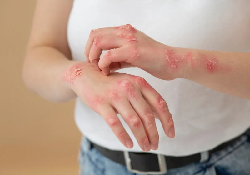 A pílula contra psoríase da Johnson & Johnson foi testada em 2.500 pacientes com estágio leve e moderado da doença. - Foto: Pixabay