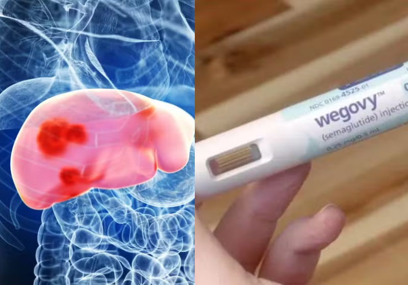 Anvisa aprovou a semaglutida para tratar gordura no fígado com inflamação. A novidade traz esperança para pacientes — Foto: Adobe Stock/Reprodução