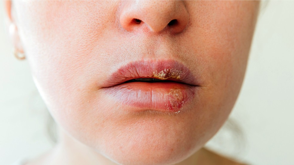 O vírus Epstein-Barr causa a “doença do beijo”. Ele permanece no corpo após a infecção - Foto: Pixabay