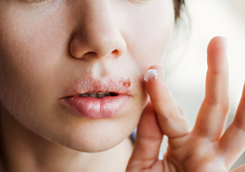 Cientistas criaram anticorpos que bloqueiam o vírus Epstein-Barr causa a “doença do beijo” - Foto: Pixabay