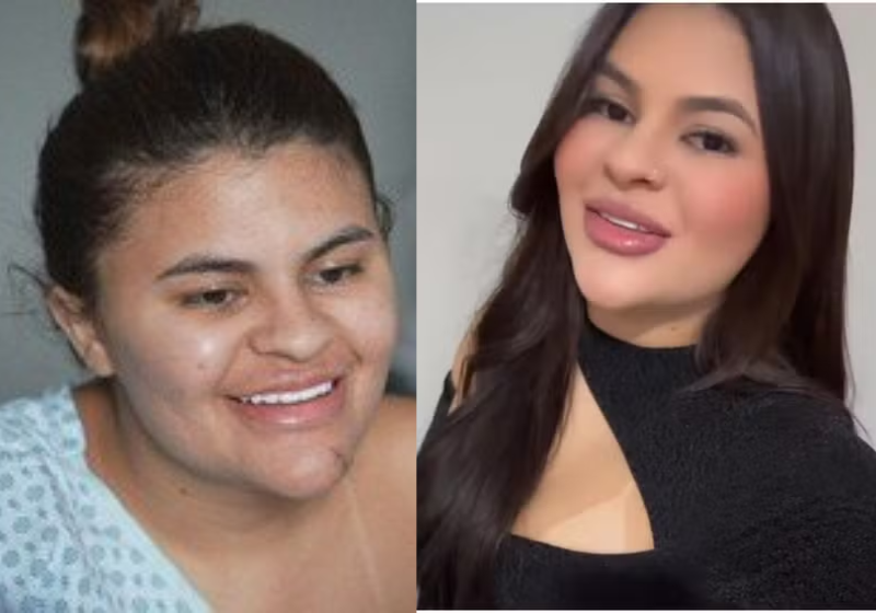 A jovem teve as mãos decepadas após discussão com namorado. Após 12 horas de cirurgia ela conseguiu os primeiros movimentos.. - Foto: Fantástico
