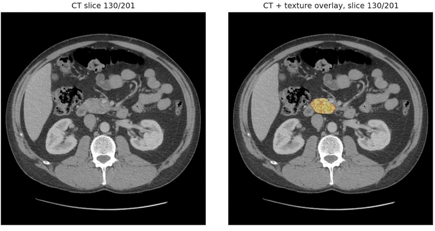 Modelo de IA REDMOD analisou tomografia computadorizada para detectar alterações teciduais precoces em casos de câncer pancreático – Foto: Clínica Mayo