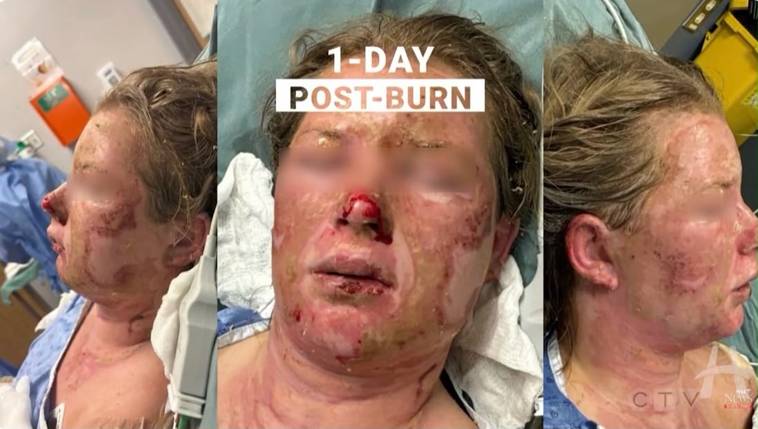 Imagens do rosto da jovem no dia seguinte ao incêndio feitas no hospital de Ontario, no Canada. - Foto: Hamilton Health Sciences