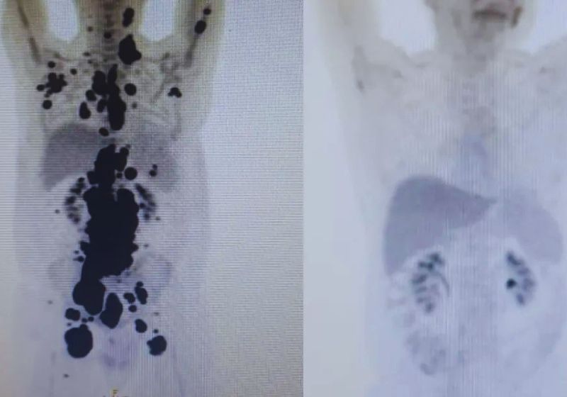 Pesquisa mostra que a terapia brasileira CAR-T Cell contra câncer teve redução significativa dos tumores em 9 em cada 10 pacientes. - Fotos: arquivo pessoal