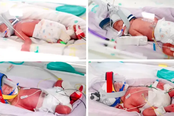 As quadrigêmeas idênticas Emily, Harriet, Catherine e Alexa nasceram saudáveis após uma gravidez raríssima na Austrália. Foto: Metro North Health