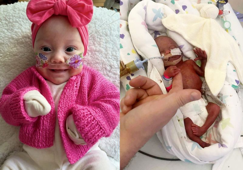 Hope, a bebê que nasceu com 22 semanas e pesando apenas 511 gramas recebeu alta após 142 dias de internação. Ela surpreendeu os médicos. - Fotos: NHS Fife / SWNS