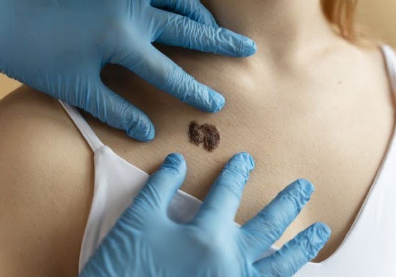 A vacina experimental contra o câncer de pele é um tratamento personalizado com RNA mensageiro, desenvolvido pela MSD e Moderna. Ela reduziu a volta do melanoma e a metástases quando combinada ao Keytruda. - Foto: Freepik
