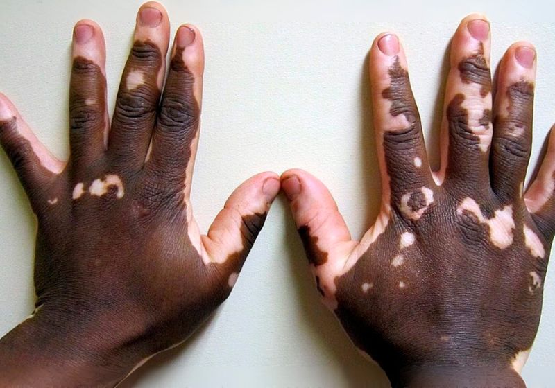 Pesquisadores da USP desenvolveram nanopartículas que conseguiram reduzir a resposta imunológica ligada ao vitiligo e estimular a volta da pigmentação em testes com camundongos em 15 dias. - Foto: James Heilman, MD/Wikimedia Commons