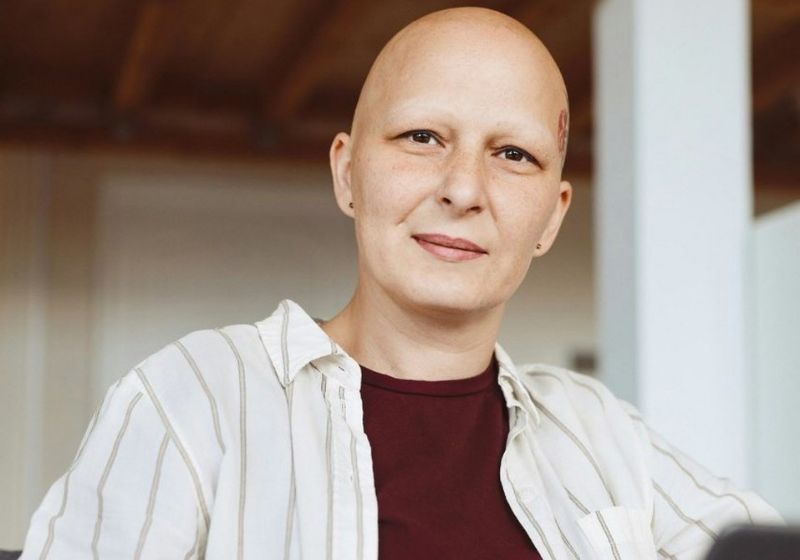 O upadacitinibe, remédio contra artrite, conseguiu recuperar grande parte do cabelo de pacientes com alopecia areata grave em dois estudos de fase 3. - Foto ilustrativa: Getty Images/ Unsplash