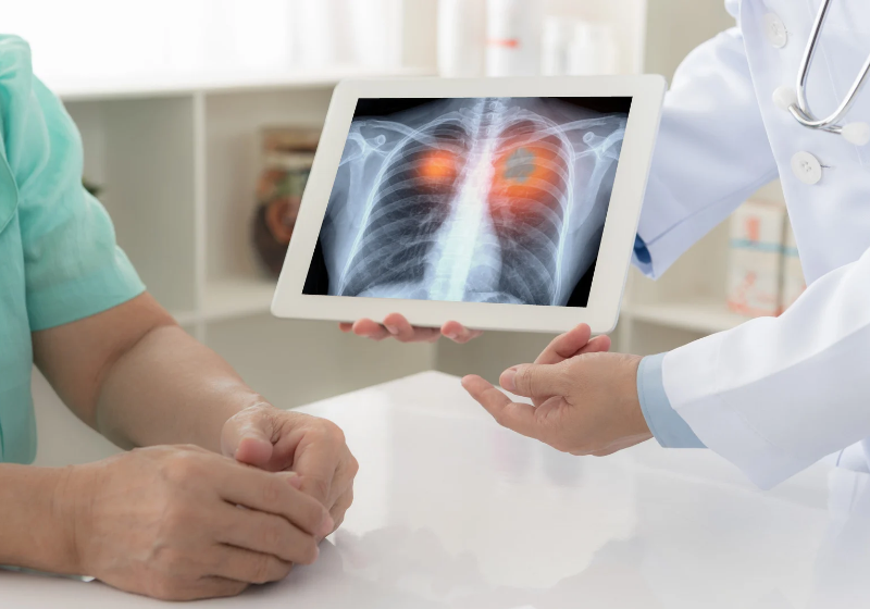 Novo medicamento aprovado pela Anvisa age diretamente em células tumorais de pacientes com determinados tipos de câncer de pulmão avançado. Foto: Canva